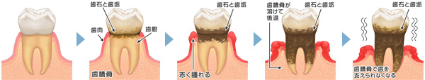 歯周病の進行図