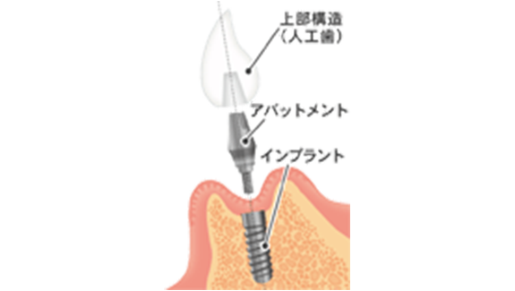 インプラント治療とは